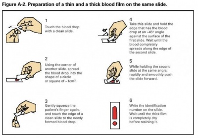 Preparation-of-a-thin-and-a-thick-blood-film-on-the-same-slide-570x397.jpg